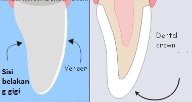 perbedaan crown dan veneer gigi